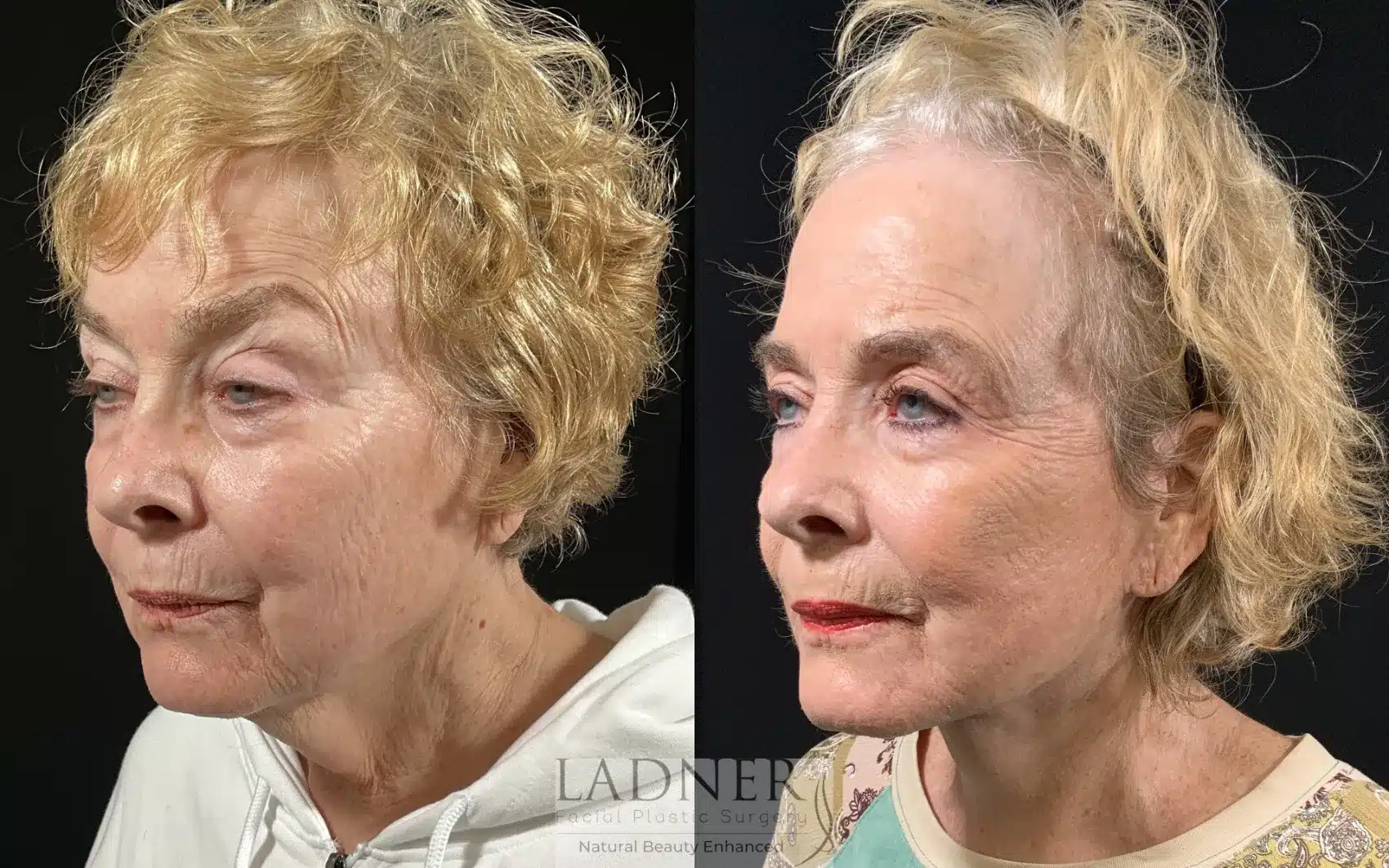 Before and After Image: Lower Deep Plane Facelift - left-front-oblique