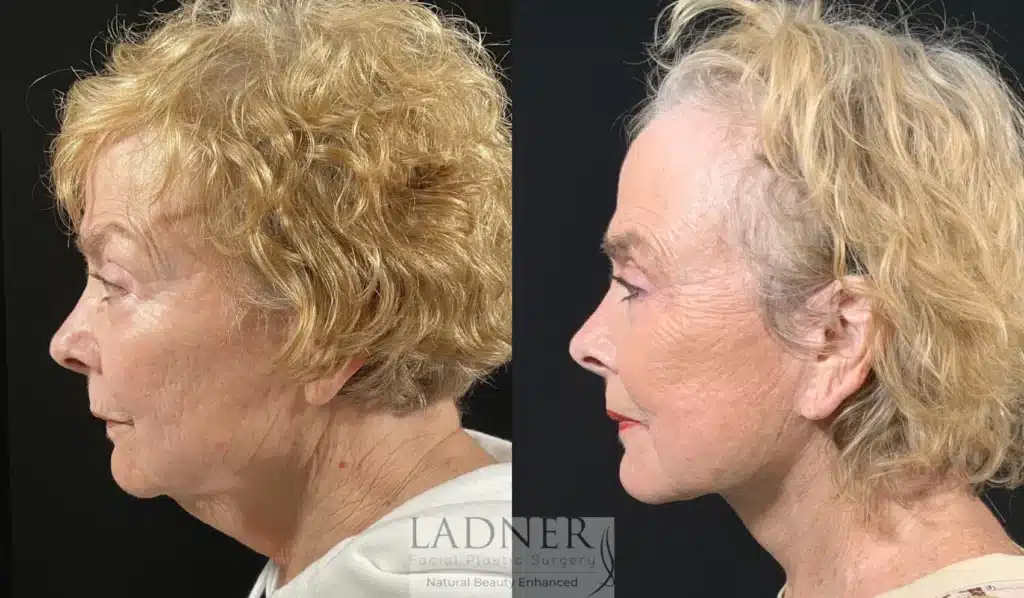 Before and After Image: Lower Deep Plane Facelift & Minimally Invasive Neck Tightening - left-side