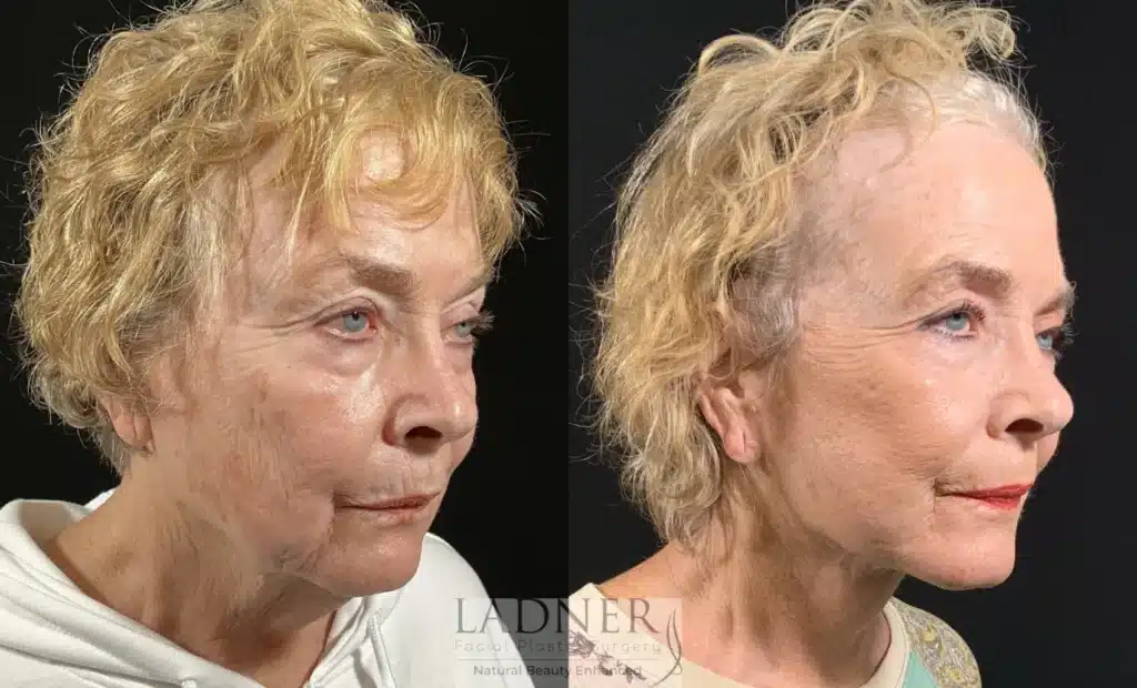 Before and After Image: Lower Deep Plane Facelift & Minimally Invasive Neck Tightening - right-front-oblique