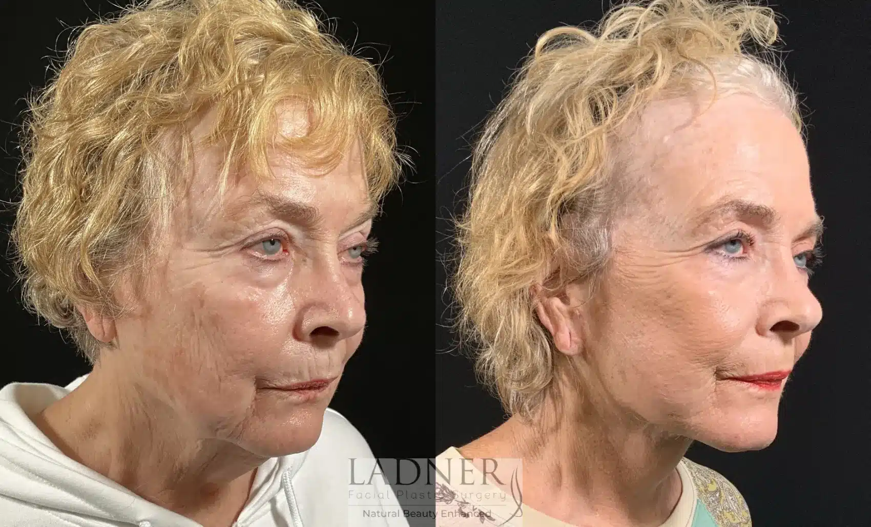 Before and After Image: Lower Deep Plane Facelift - right-front-oblique