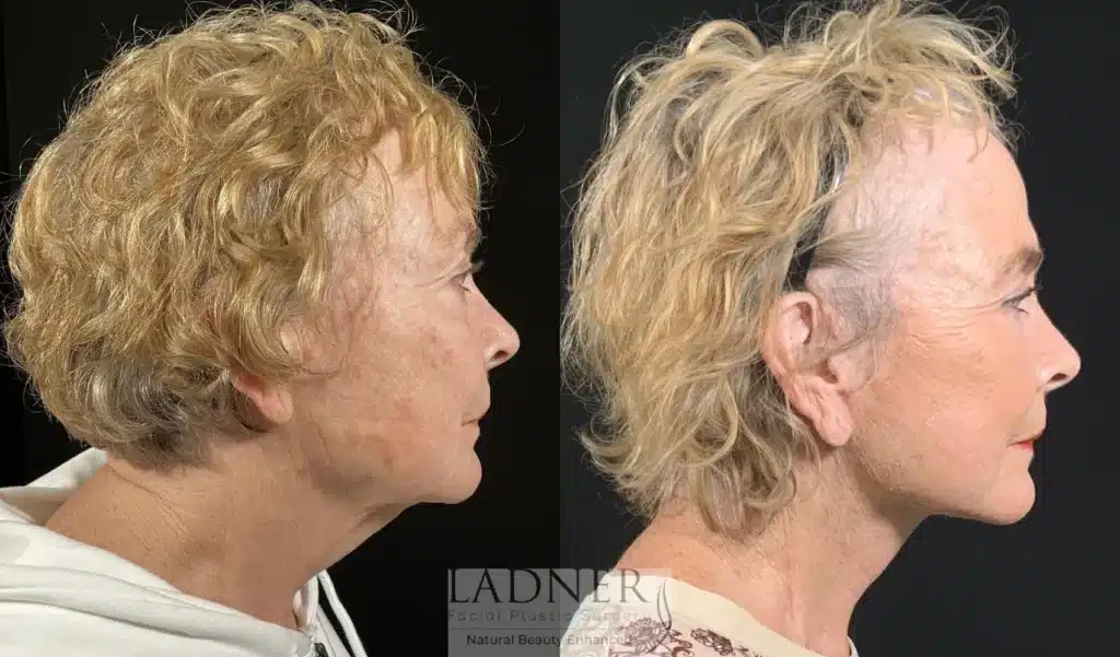 Before and After Image: Lower Deep Plane Facelift & Minimally Invasive Neck Tightening - right-side