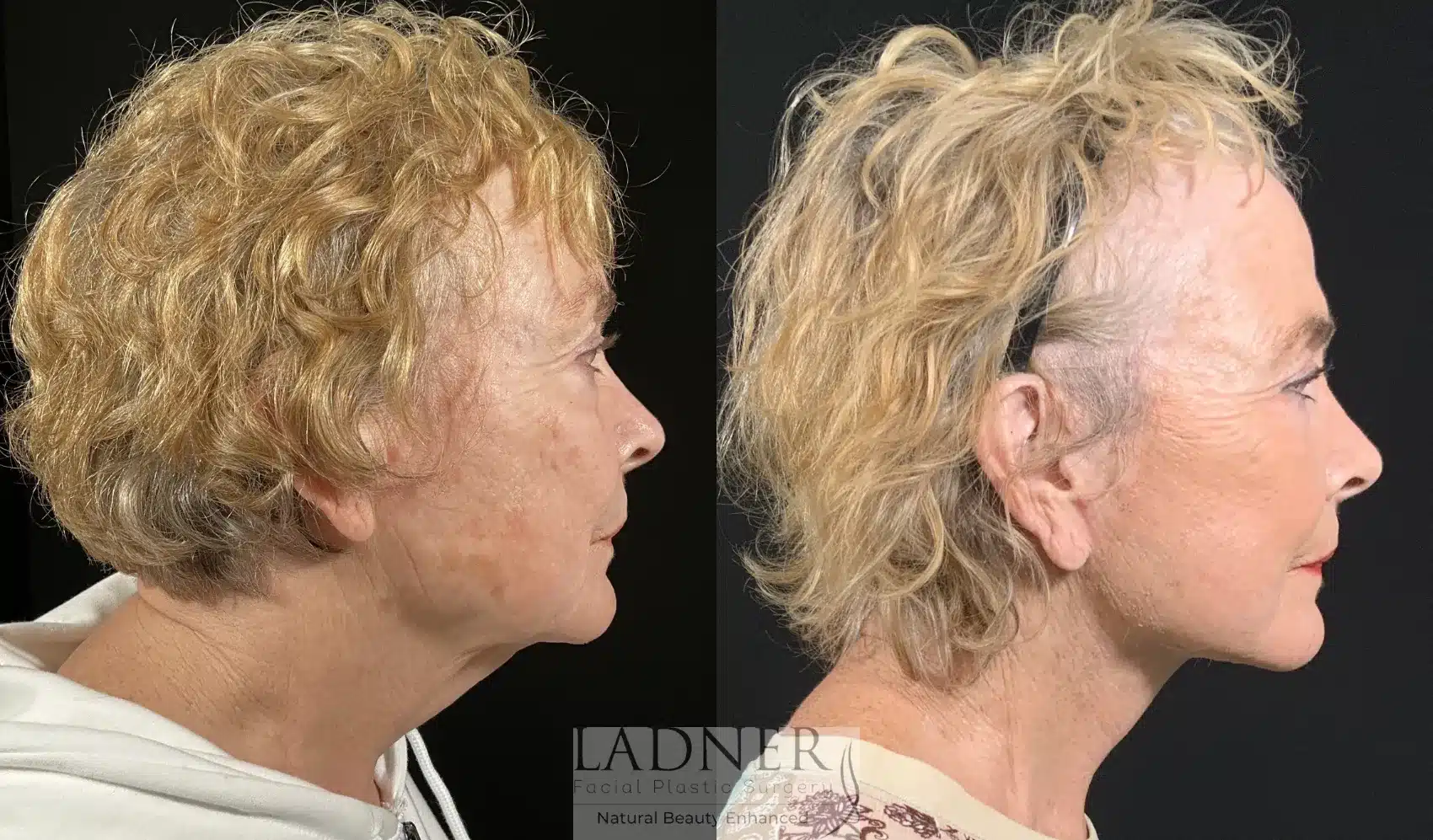 Before and After Image: Lower Deep Plane Facelift - right-side