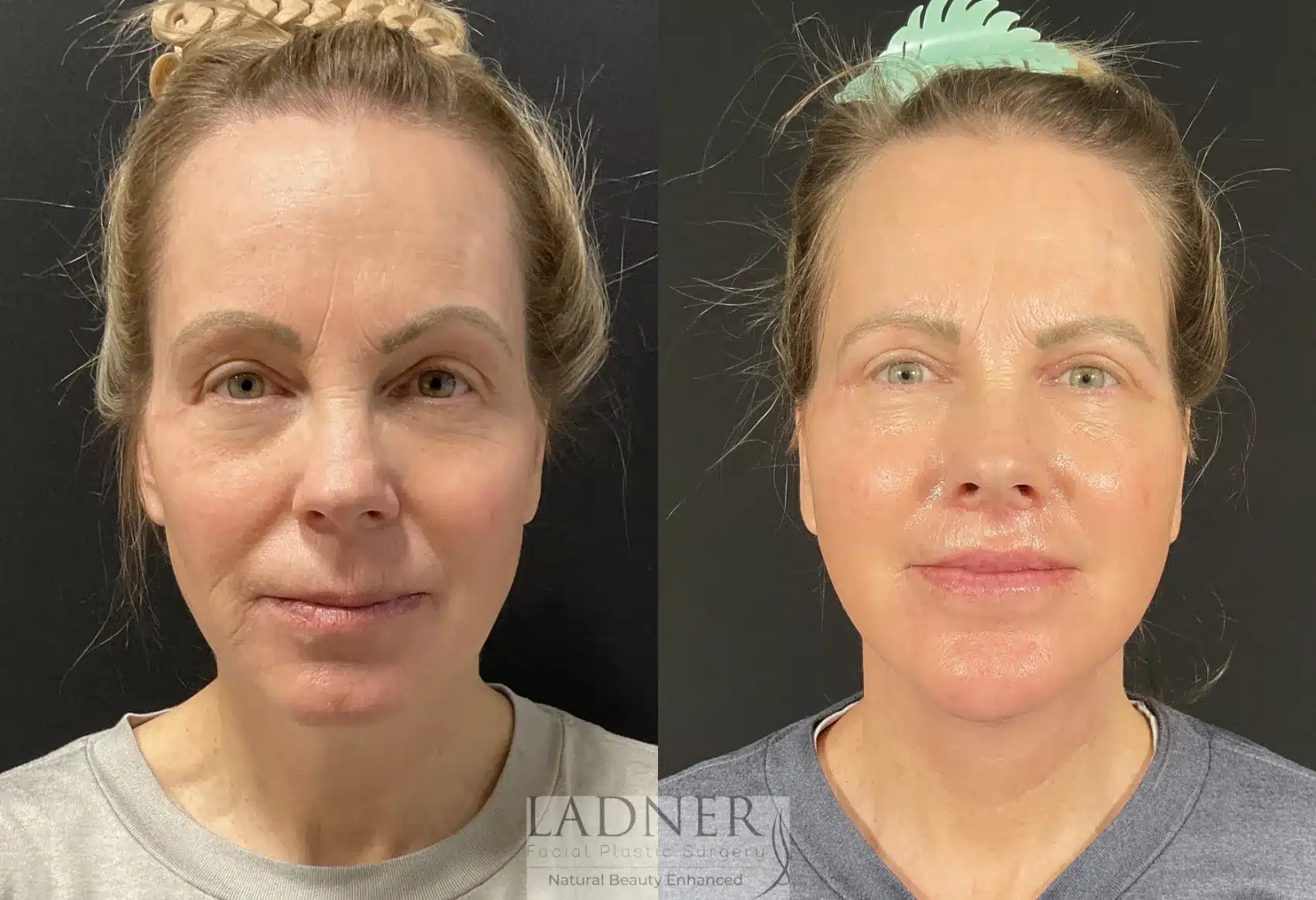 Before and After Image: Lower Deep Plane Facelift - front
