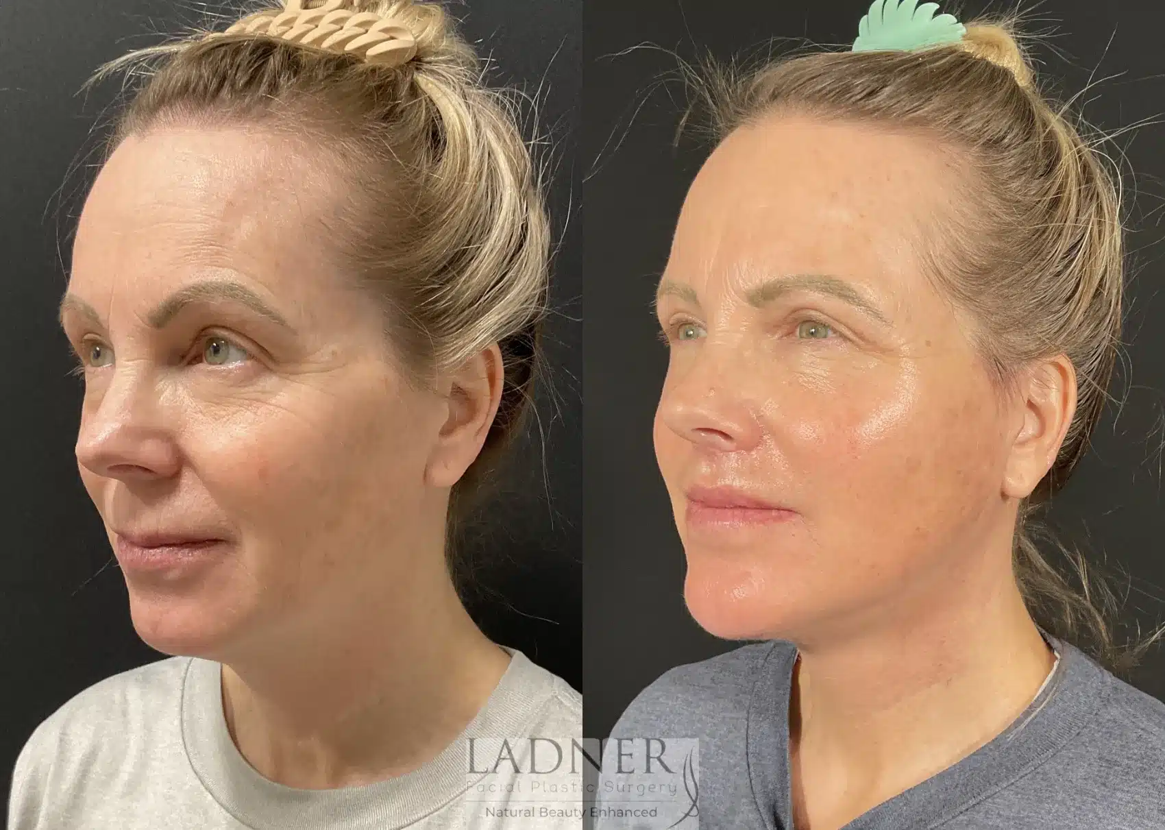 Before and After Image: Lower Deep Plane Facelift - left-front-oblique