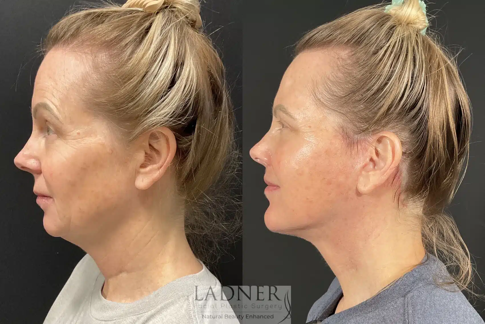 Before and After Image: Lower Deep Plane Facelift - left-side