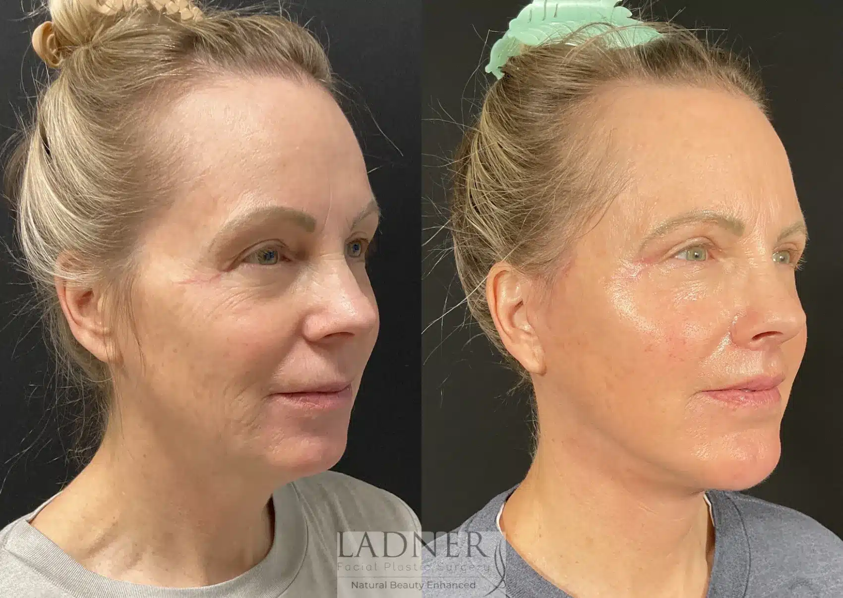 Before and After Image: Lower Deep Plane Facelift - right-front-oblique