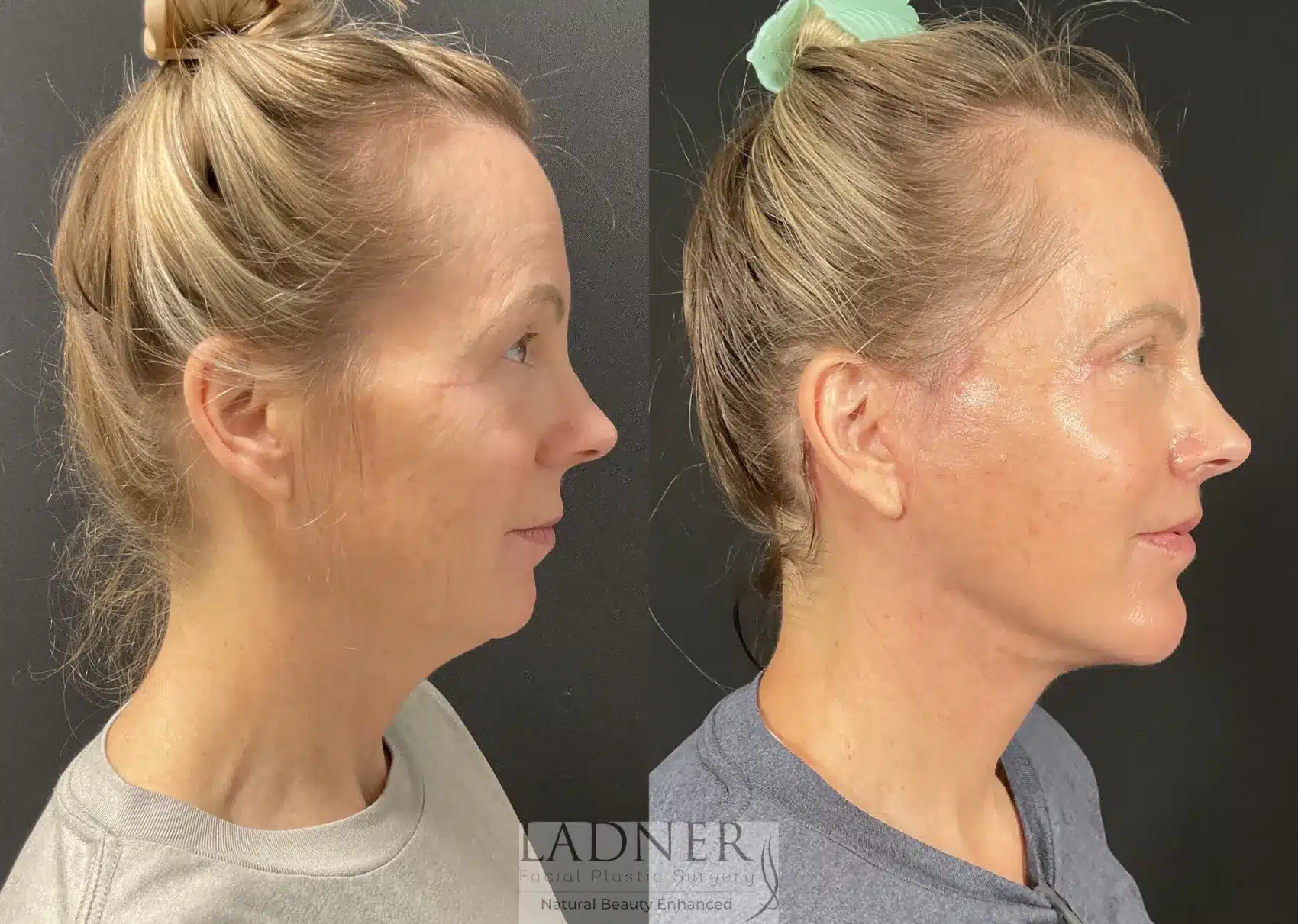 Before and After Image: Lower Deep Plane Facelift - right-side