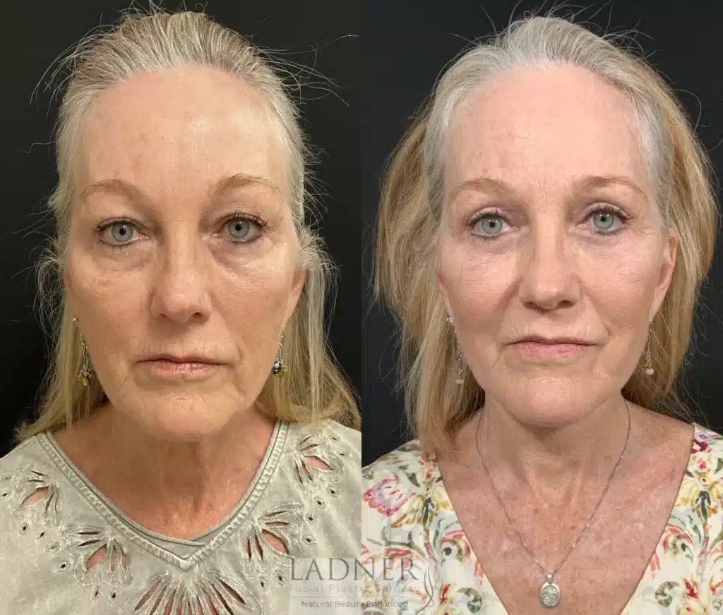 Before and After Image: Lower Deep Plane Facelift & Blepharoplasty - front