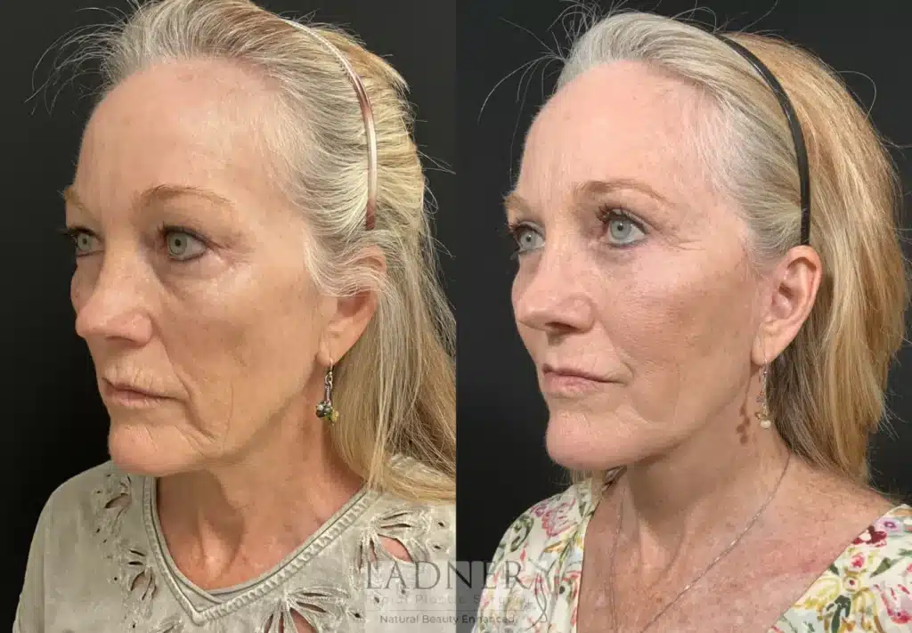 Before and After Image: Lower Deep Plane Facelift & Blepharoplasty - left-front-oblique