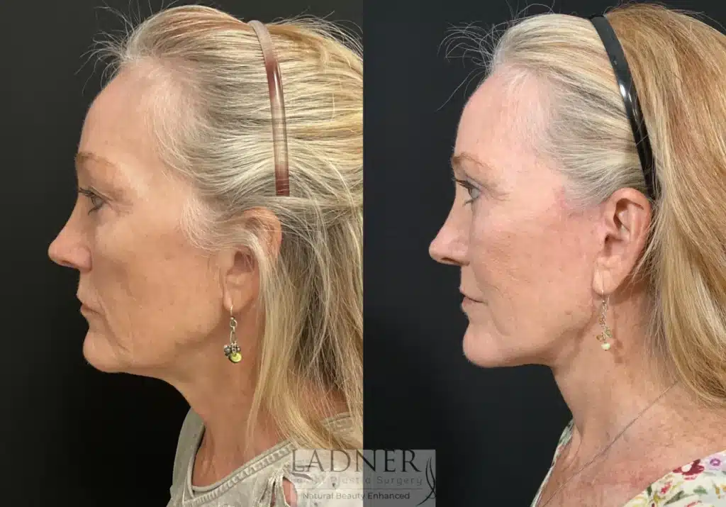 Before and After Image: Lower Deep Plane Facelift & Blepharoplasty - left-side