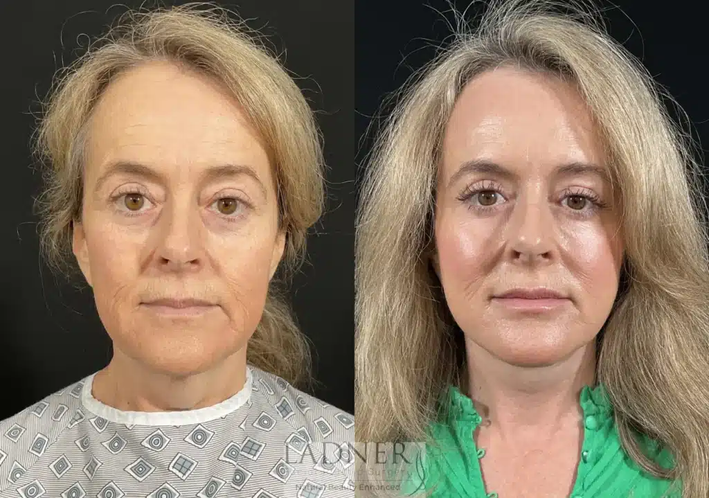 Before and After Image: Deep Plane Facelift/Neck Lift, Revision Upper Blepharoplasty, and Brow Lift/Forehead Lift - front