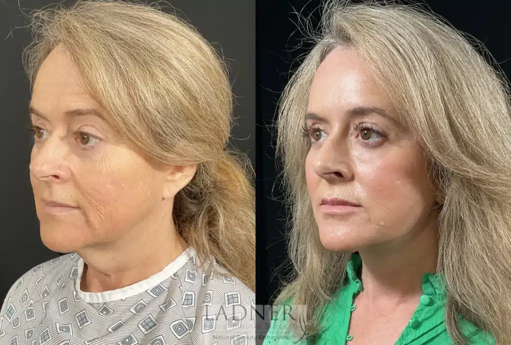 Before and After Image: Deep Plane Facelift/Neck Lift, Revision Upper Blepharoplasty, and Brow Lift/Forehead Lift - left-front-oblique