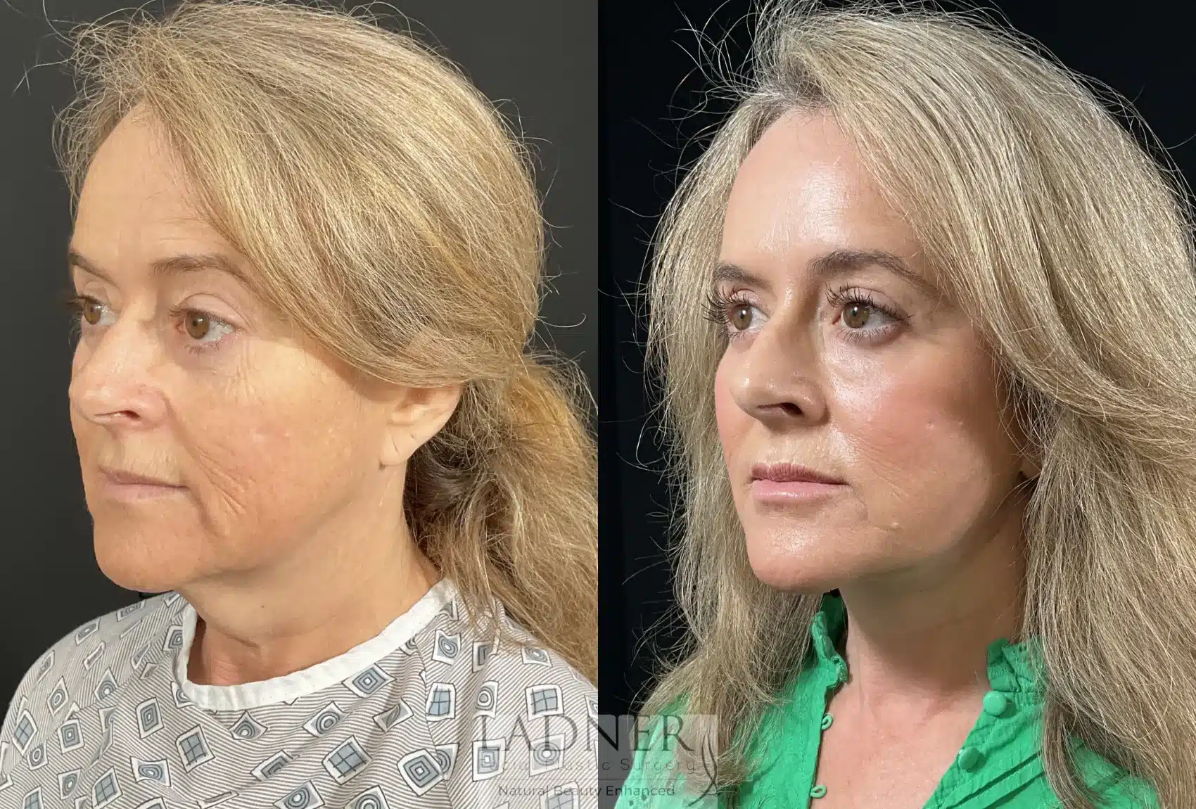 Before and After Image: Deep Plane Facelift/Neck Lift - left-front-oblique