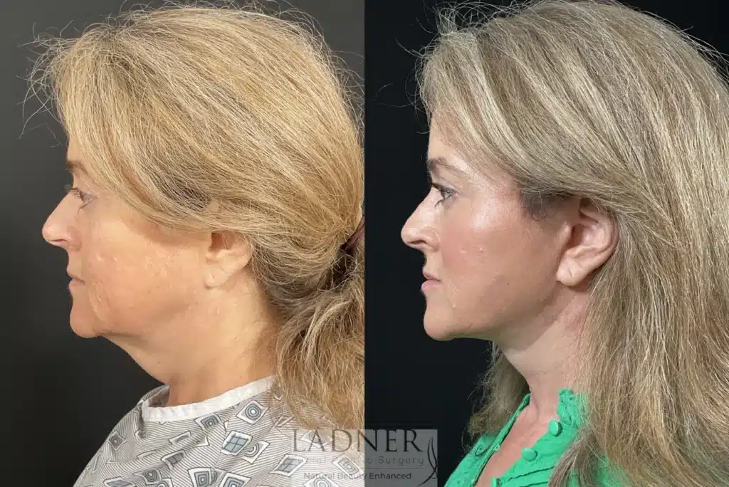 Before and After Image: Deep Plane Facelift/Neck Lift, Revision Upper Blepharoplasty, and Brow Lift/Forehead Lift - left-side