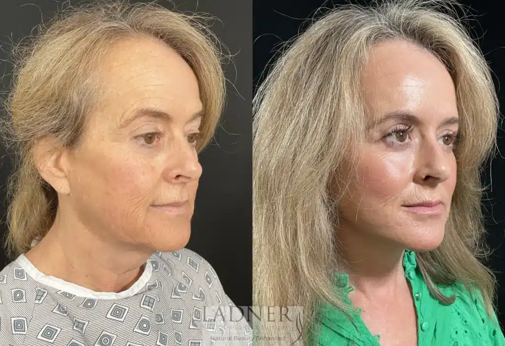 Before and After Image: Deep Plane Facelift/Neck Lift, Revision Upper Blepharoplasty, and Brow Lift/Forehead Lift - right-front-oblique