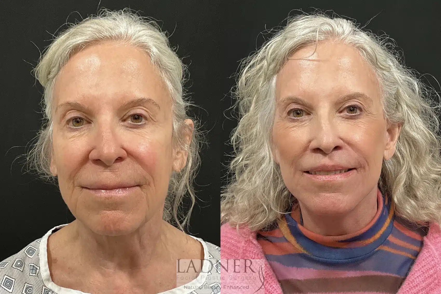 Before and After Image: Deep Plane Facelift/Neck Lift - front