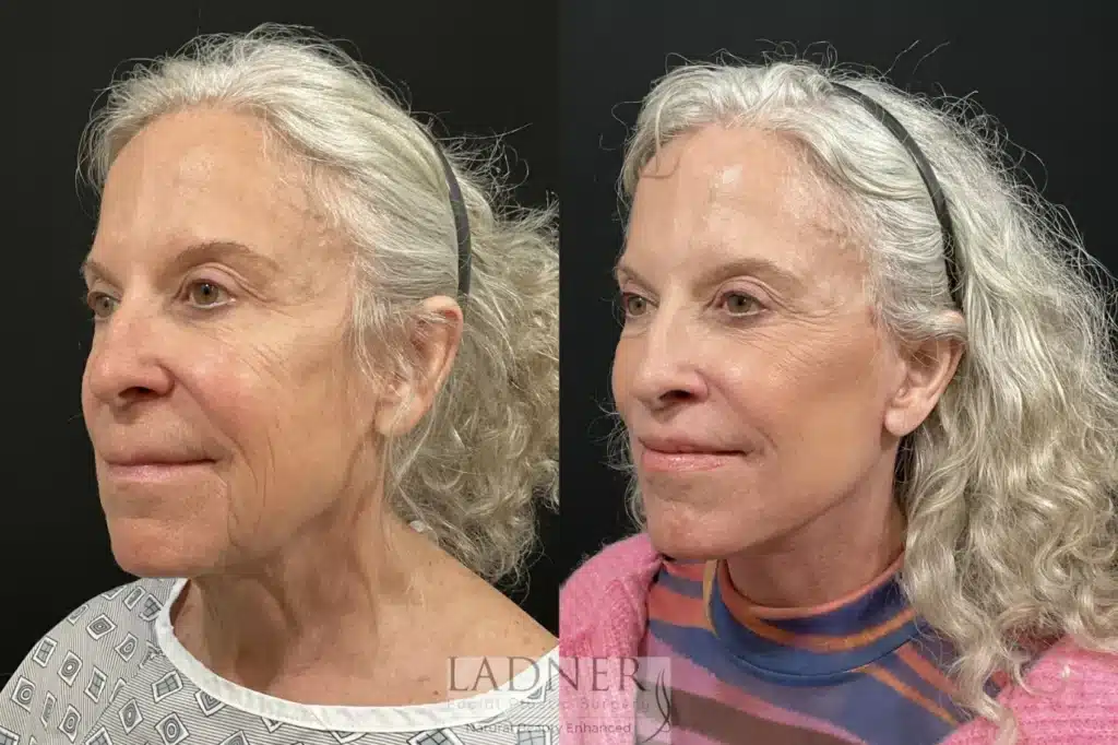 Before and After Image: Deep Plane Facelift/Neck Lift - left-front-oblique