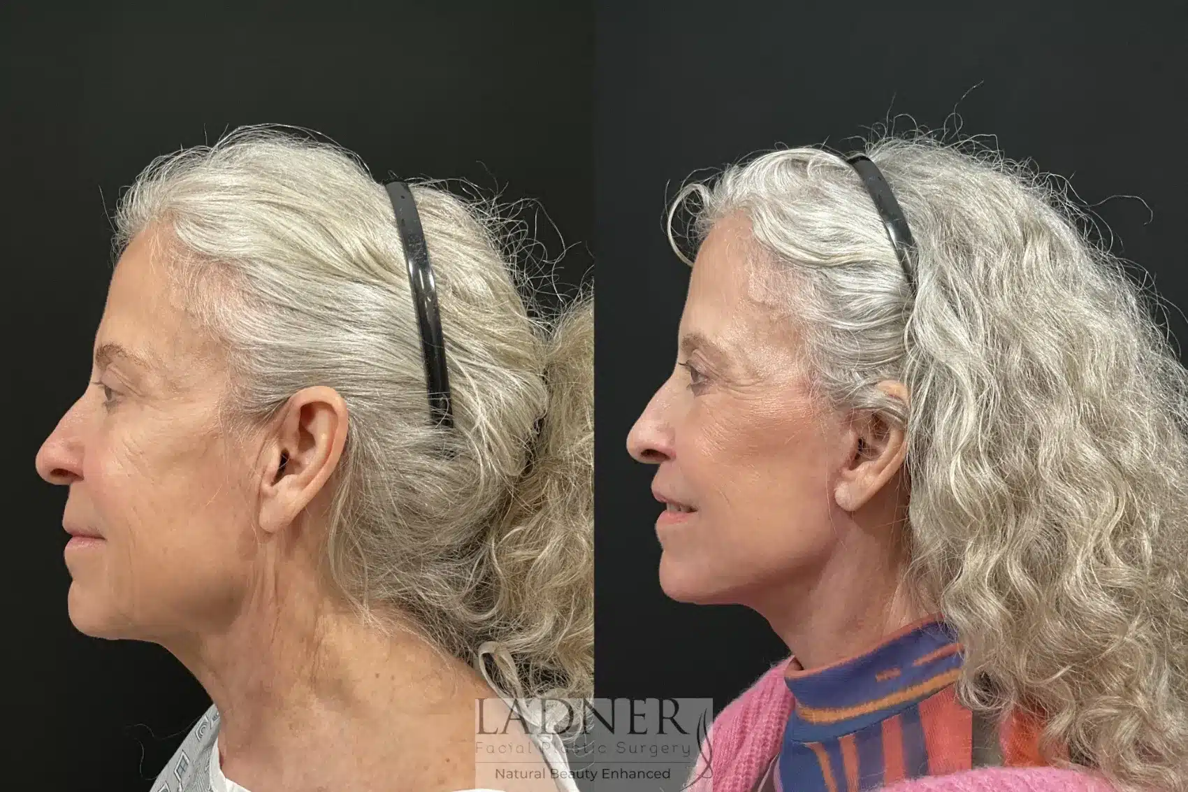 Before and After Image: Deep Plane Facelift/Neck Lift - left-side
