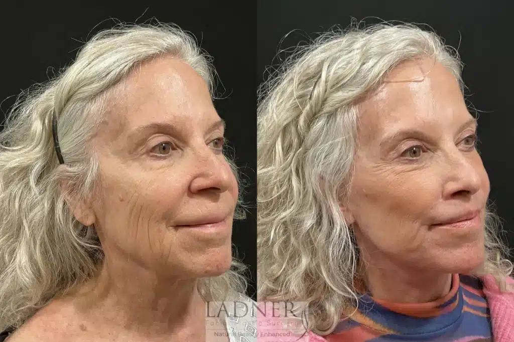 Before and After Image: Deep Plane Facelift/Neck Lift - right-front-oblique