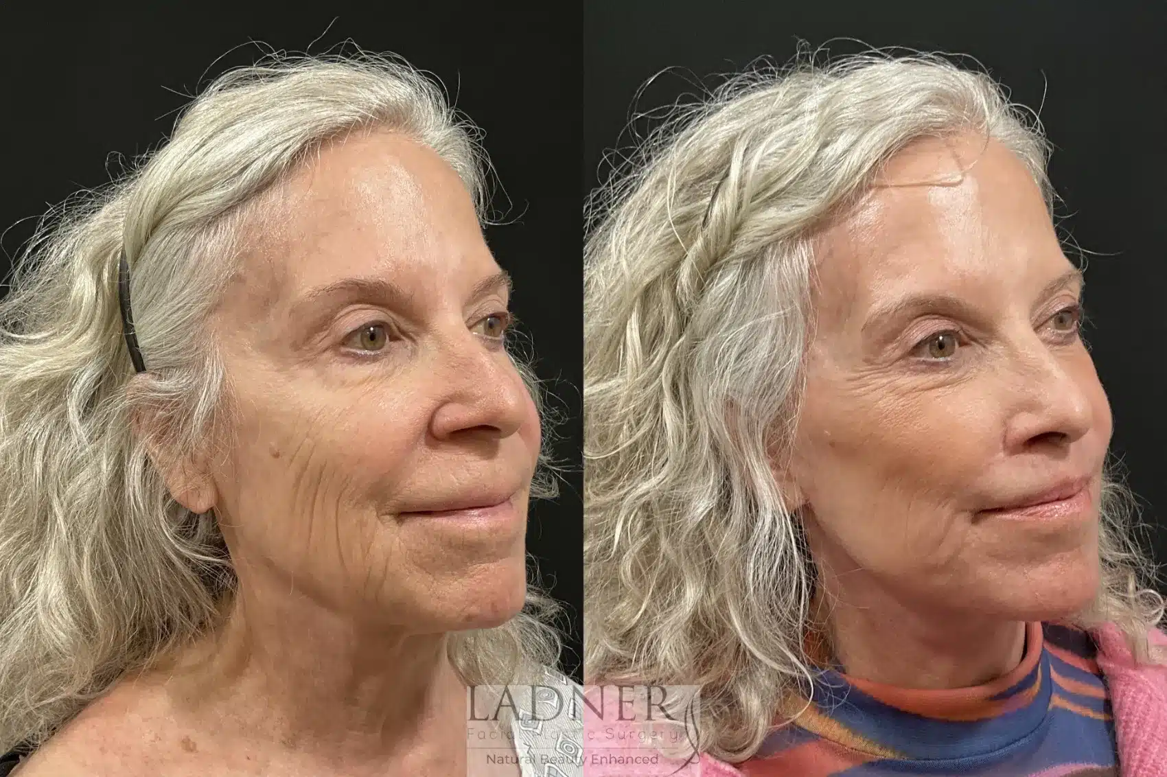 Before and After Image: Deep Plane Facelift/Neck Lift - right-front-oblique