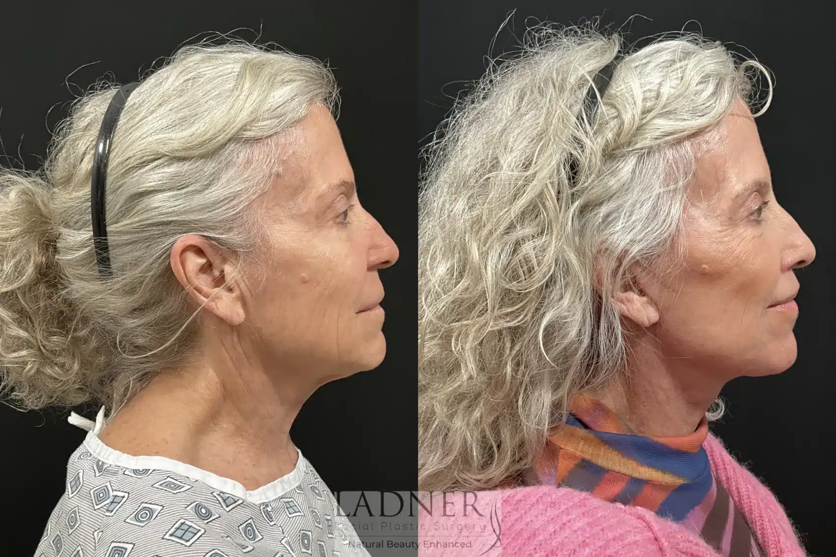Before and After Image: Deep Plane Facelift/Neck Lift - right-side