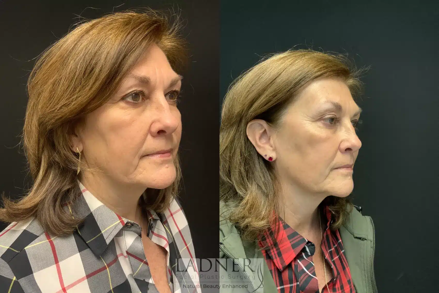 Before and After Image: Facial Balancing - right-front-oblique