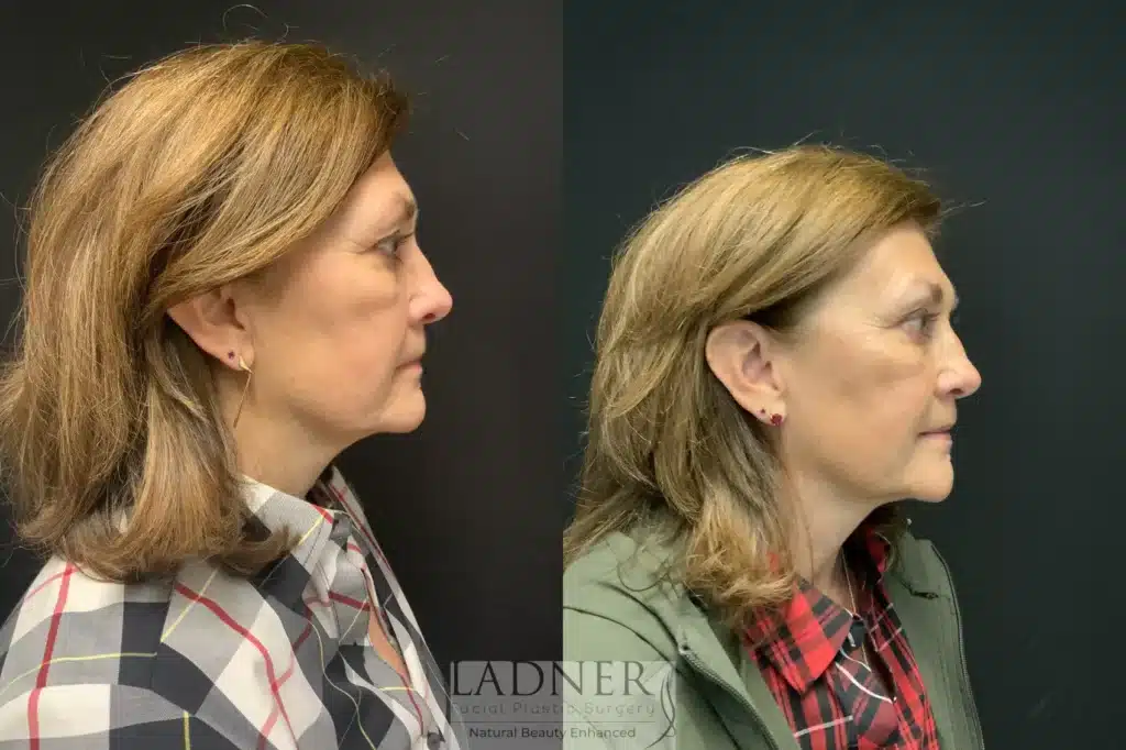 Before and After Image: Facial Balancing - right-side