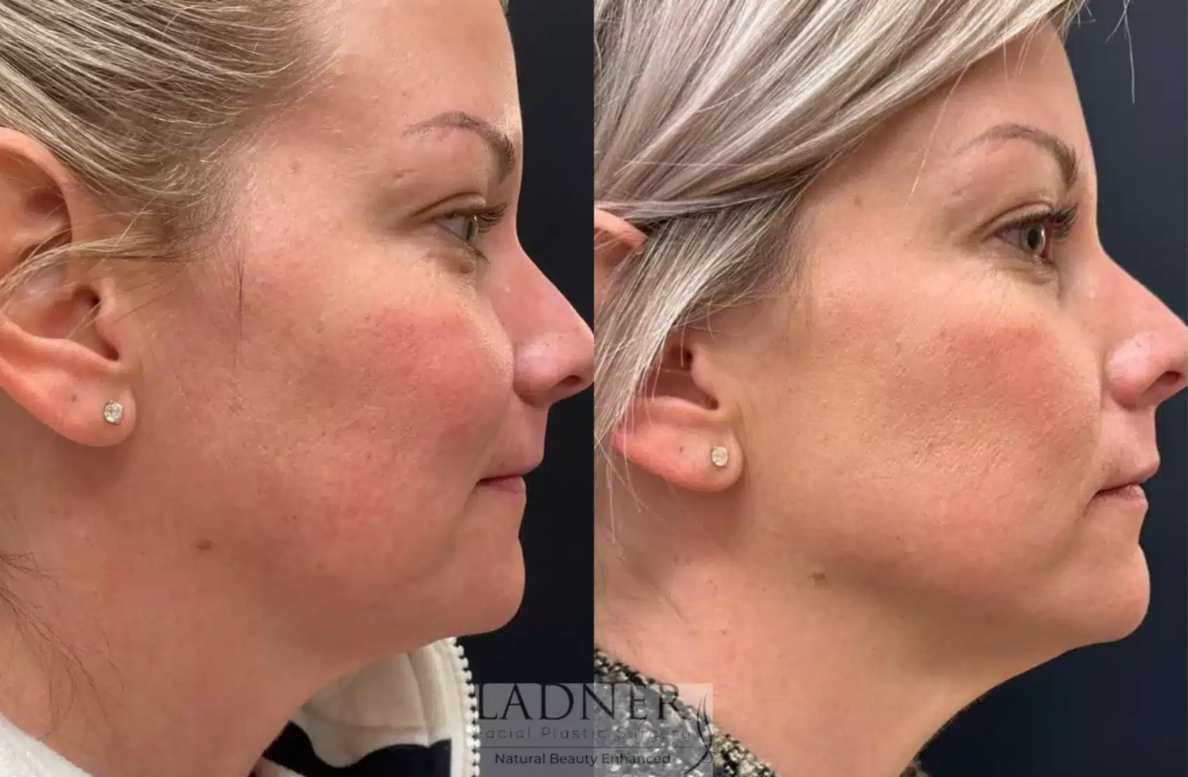 Before and After Image: Facial Balancing - right-side