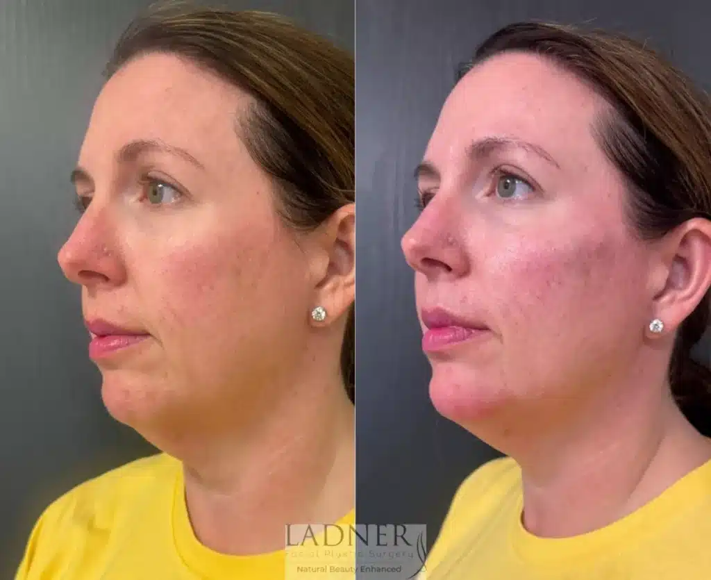 Before and After Image: Facial Balancing - left-front-oblique