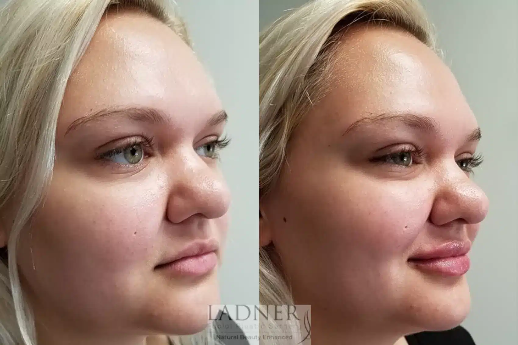 Before and After Image: Facial Balancing - right-front-oblique