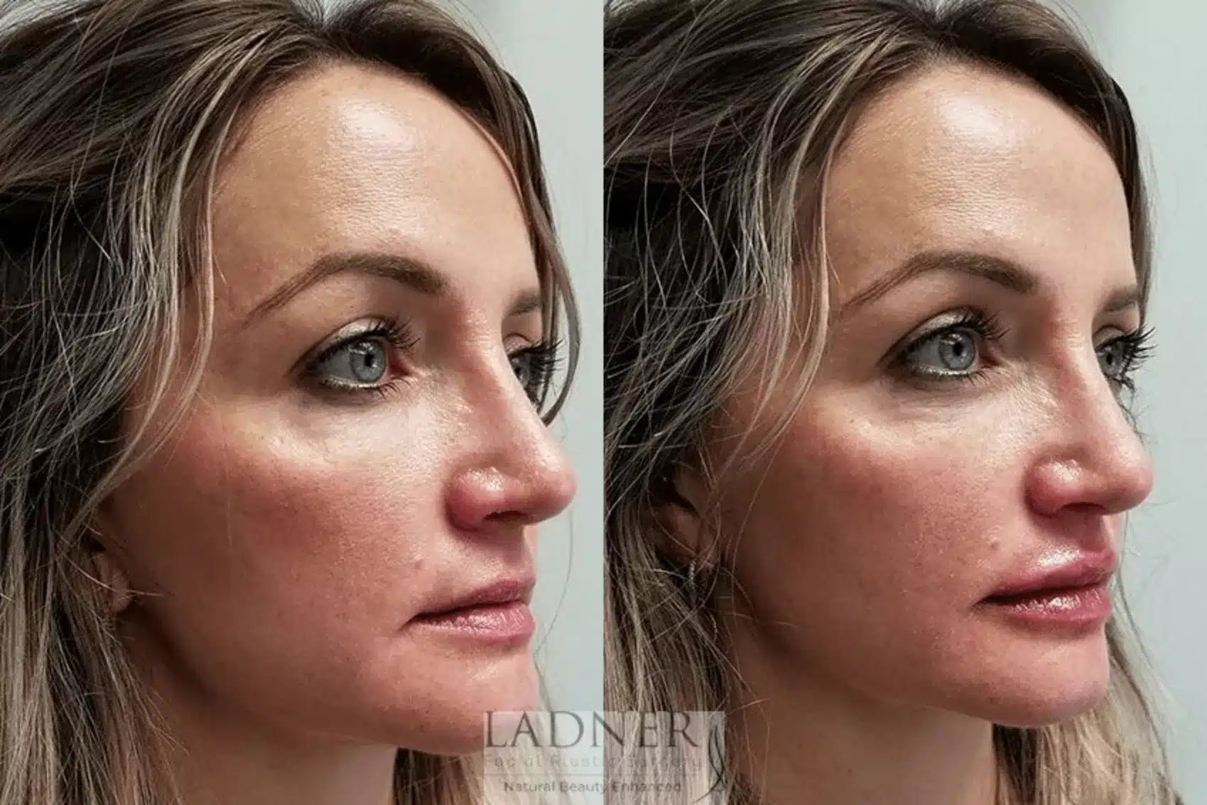 Before and After Image: Facial Balancing - right-front-oblique