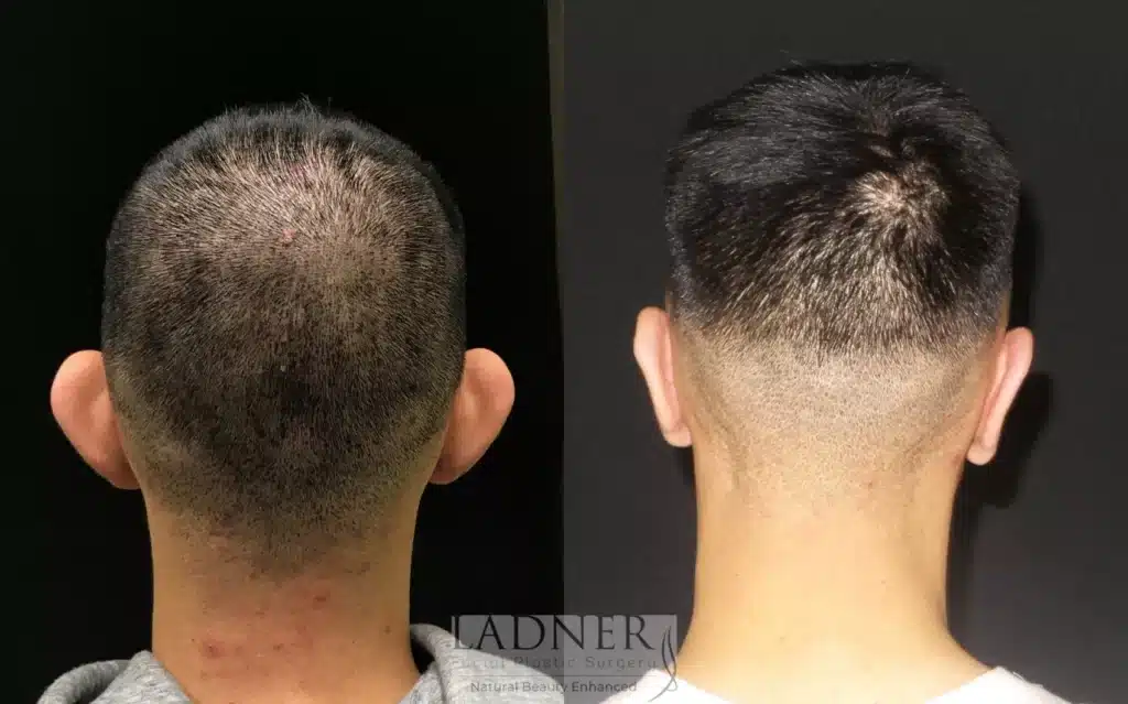 Before and After Image: Ear Surgeries & Facial Plastic Surgery for Men - back