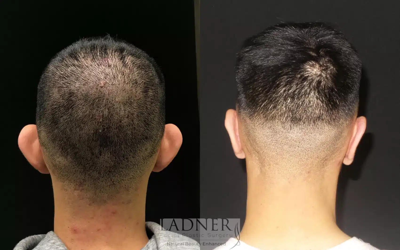 Before and After Image: Ear Surgeries - back
