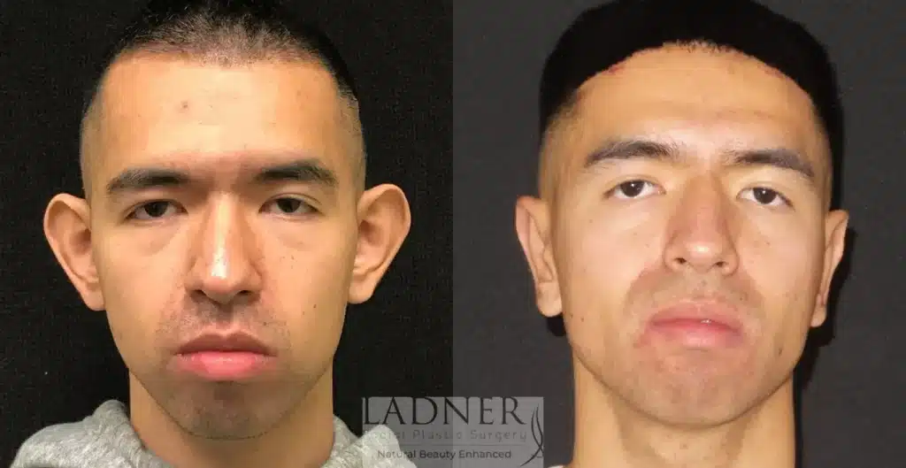Before and After Image: Ear Surgeries & Facial Plastic Surgery for Men - front