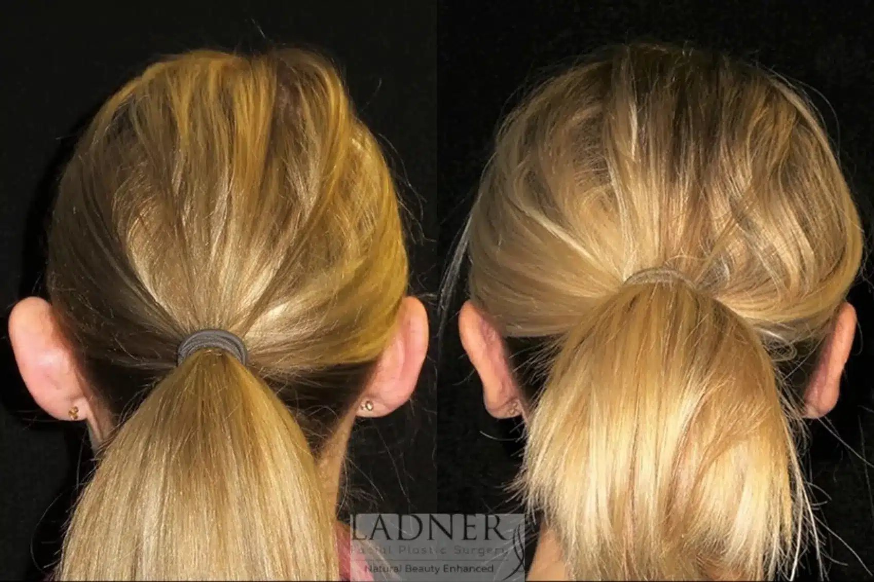 Before and After Image: Ear Surgeries - back