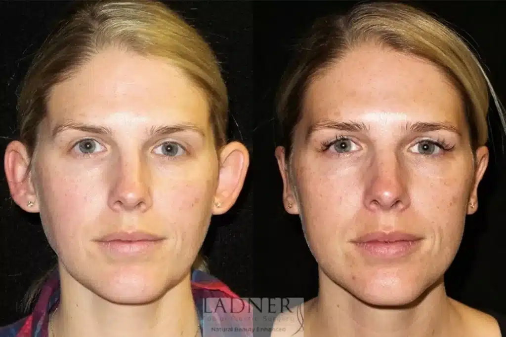 Before and After Image: Ear Surgeries - front