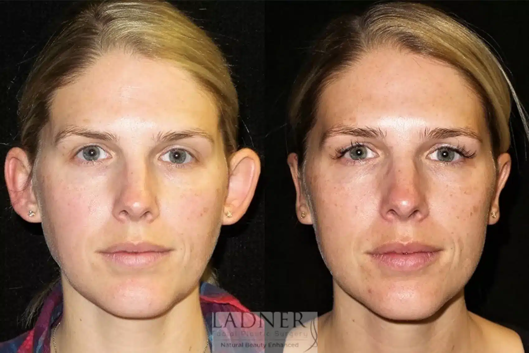 Before and After Image: Ear Surgeries - front