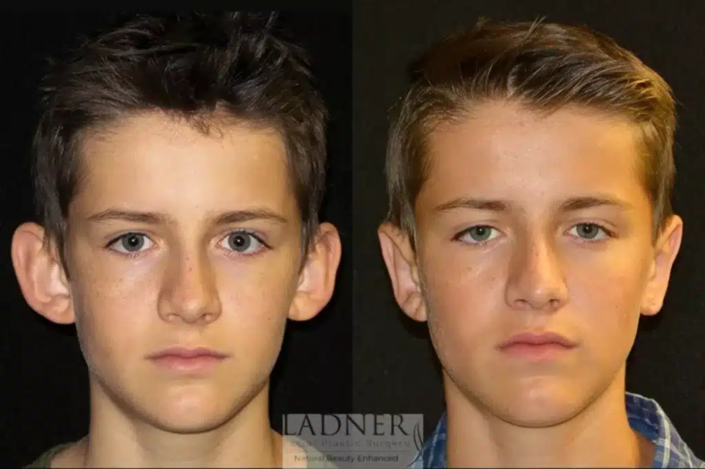 Before and After Image: Ear Surgeries - front
