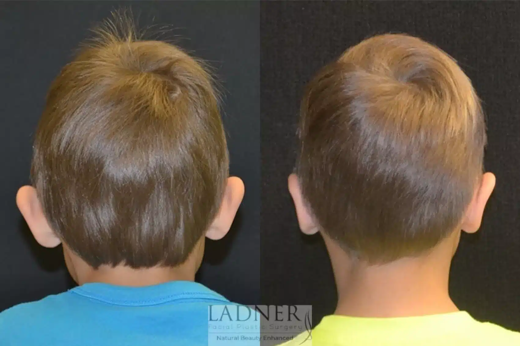 Before and After Image: Ear Surgeries - back