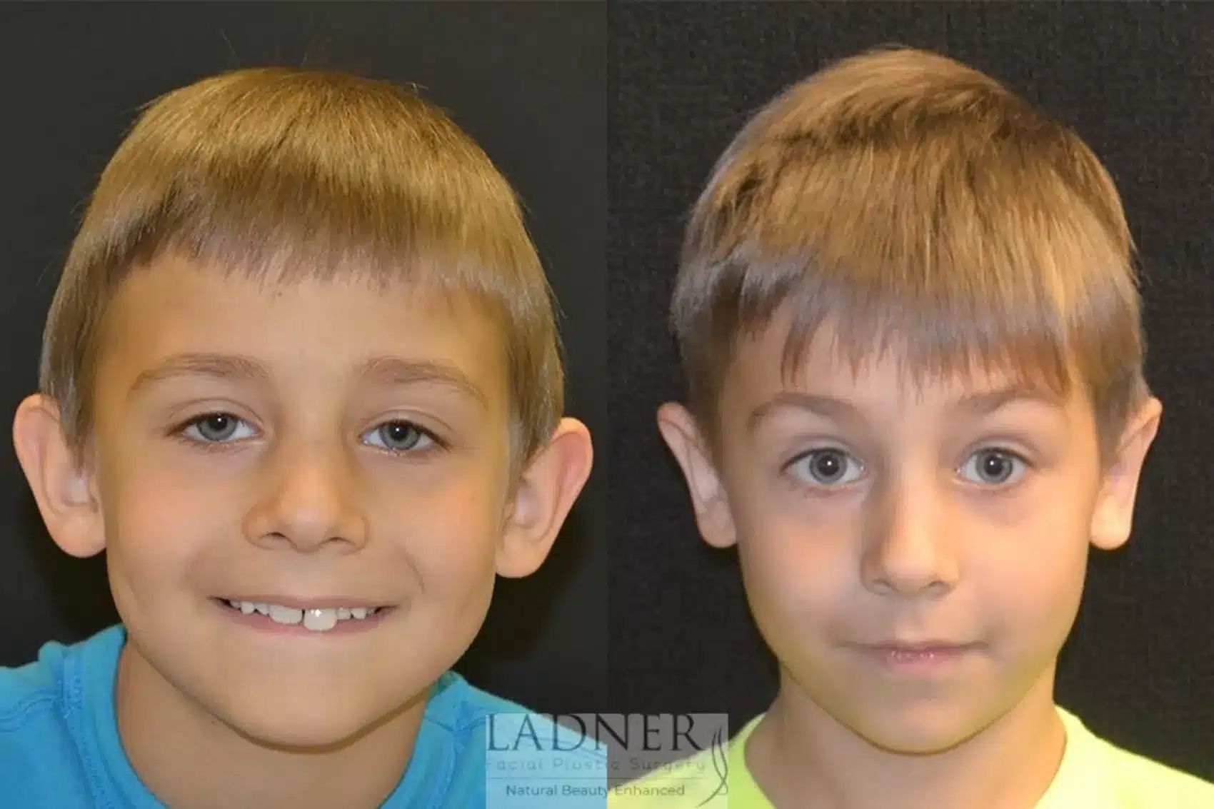 Before and After Image: Ear Surgeries - front