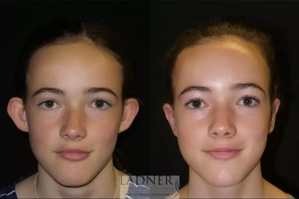 Before and After Image: Ear Surgeries - front