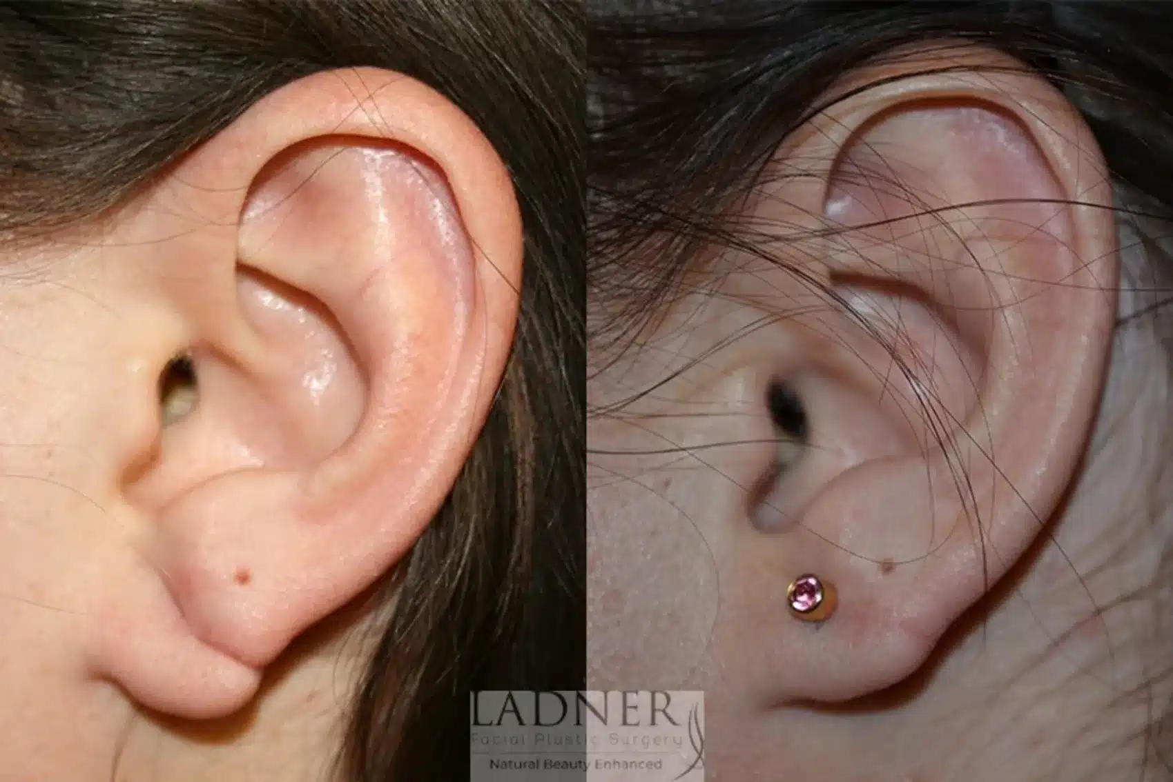 Before and After Image: Ear Surgeries - left-side