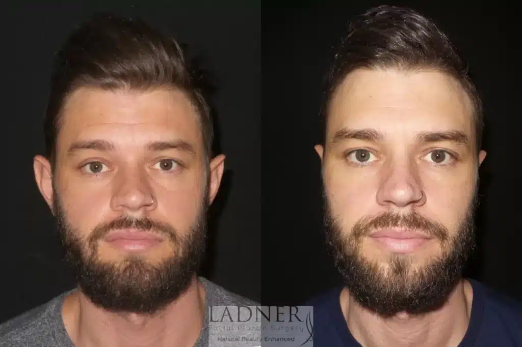 Before and After Image: Ear Surgeries & Facial Plastic Surgery for Men - front