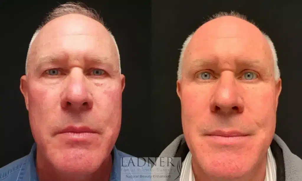 Before and After Image: Upper Blepharoplasty & Facial Plastic Surgery for Men - front