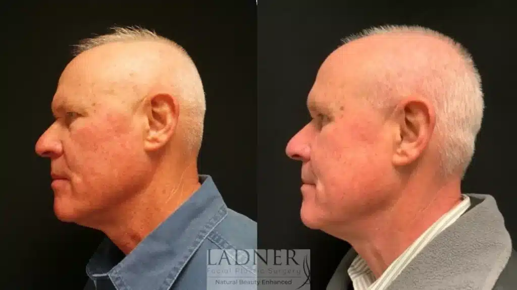 Before and After Image: Upper Blepharoplasty & Facial Plastic Surgery for Men - left-side