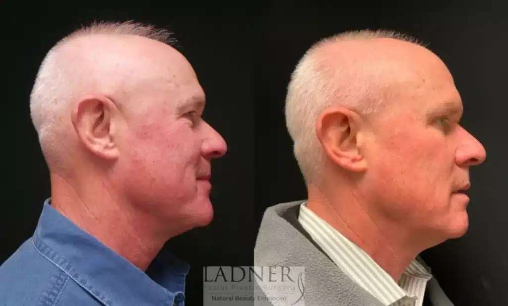 Before and After Image: Upper Blepharoplasty & Facial Plastic Surgery for Men - right-side