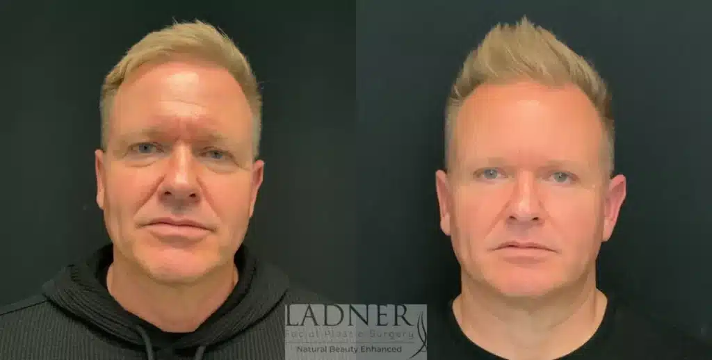 Before and After Image: Upper and Lower Blepharoplasty & Facial Plastic Surgery for Men - front