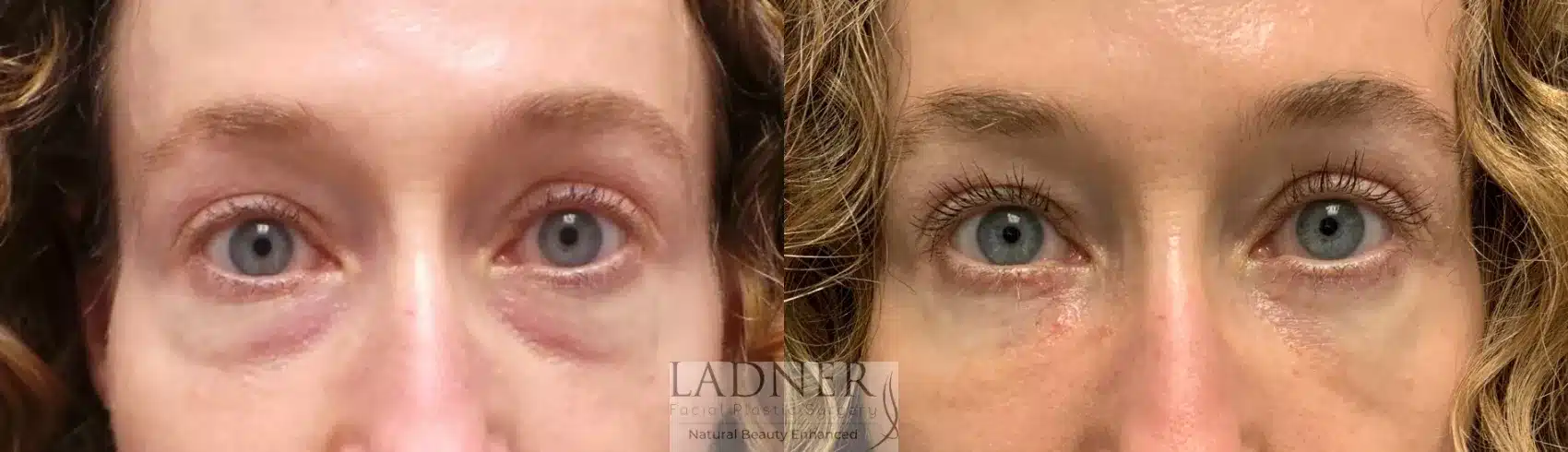 Before and After Image: Lower Blepharoplasty - front