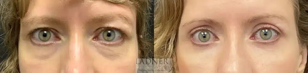 Before and After Image: Upper and Lower Blepharoplasty - front