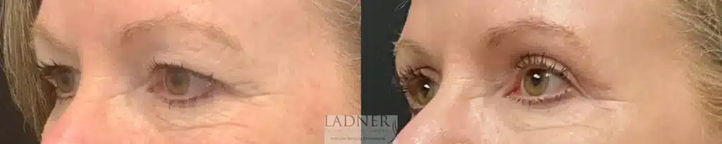 Before and After Image: Upper Blepharoplasty - left-front-oblique